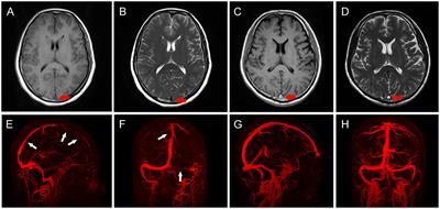 Predictive Factors for Early-Onset Seizures in Patients With Cerebral Venous Sinus Thrombosis